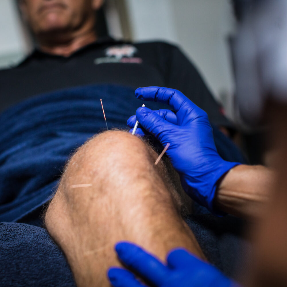 Acupuncture