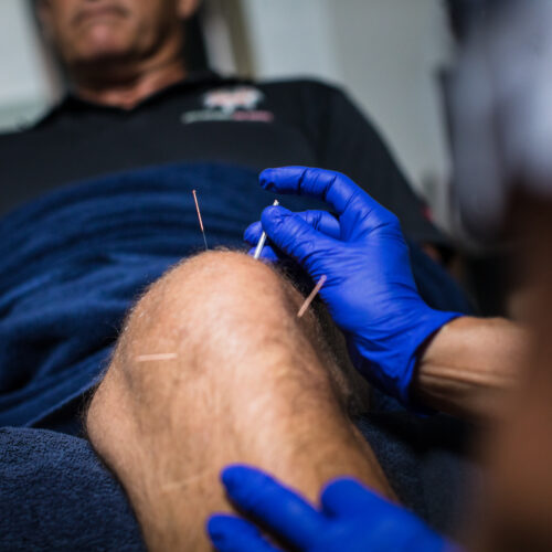 Acupuncture